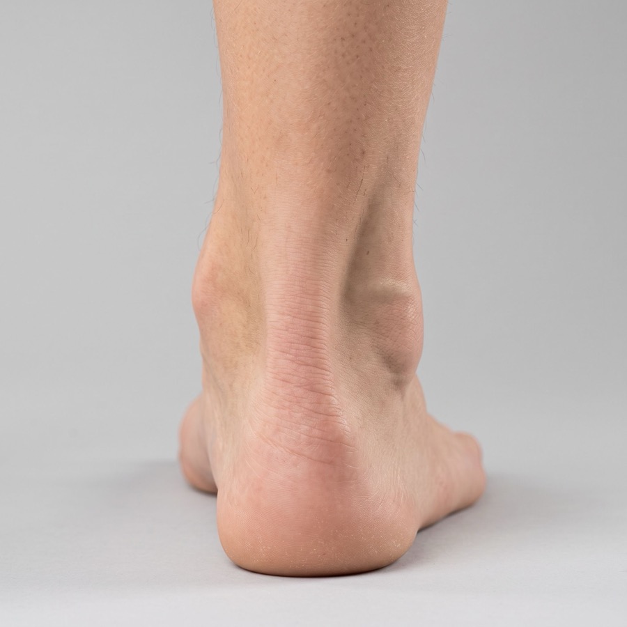 Achilles Tendonitis