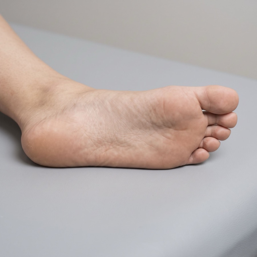 Diabetic Feet