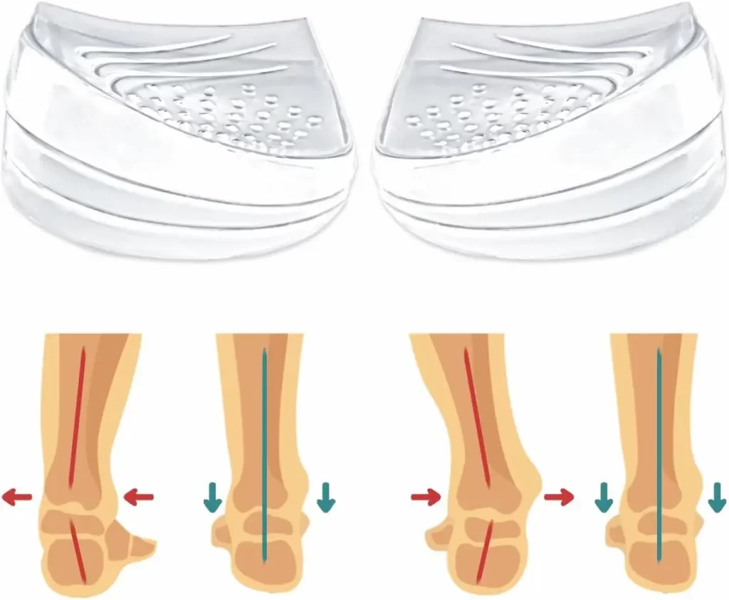 best supination insoles to reduce knee pain